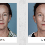 Secondary Facelift Surgery: General Overview of Why You Would Get One