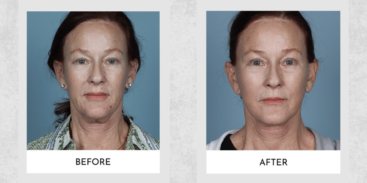 Secondary Facelift Surgery: General Overview of Why You Would Get One